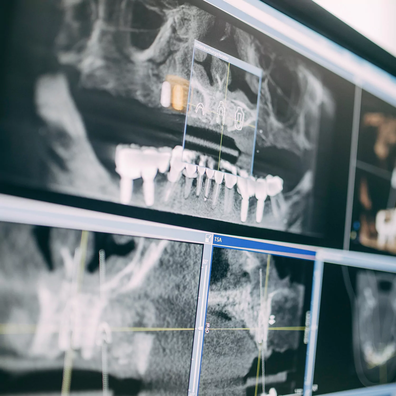 Eine Detailaufnahme einer Röntgenaufnahme zur digitalen Planung von Implantaten bei den Zahnärzten am Lutherplatz in Langen.